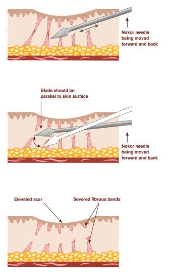 패인 흉터에 직빵이라는 치료 방법 - 이미지 1